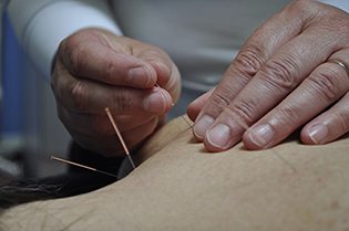 We use acupuncture to restore, promote and maintain good health by stimulating the body’s natural healing mechanisms.